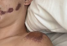 Így válhat súlyos balesetté egy ártatlan rollerezés