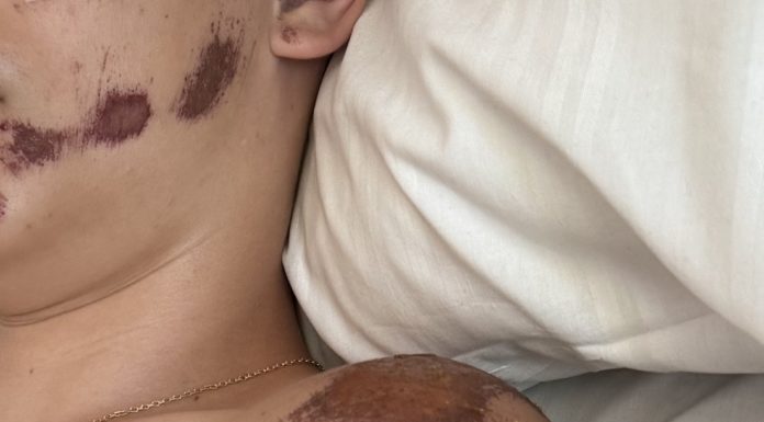 Így válhat súlyos balesetté egy ártatlan rollerezés